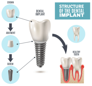 Dental Implant