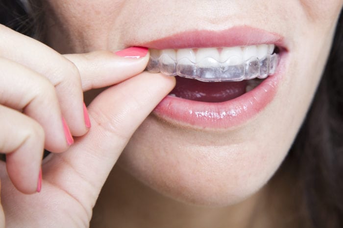 girl removing clear aligner from upper teeth