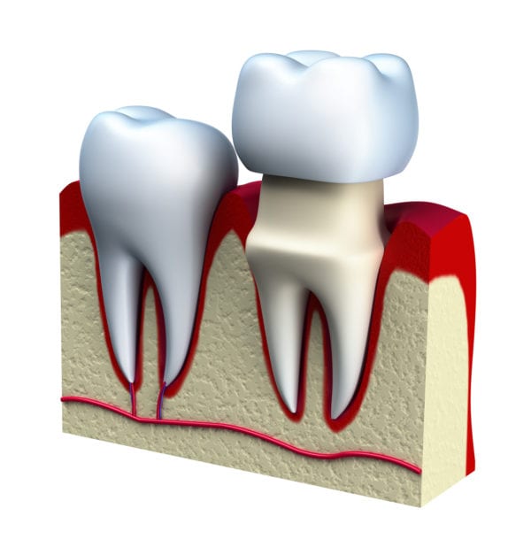 Dental crown installation process, isolated on white