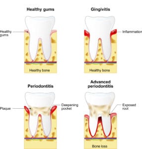 Gum Disease