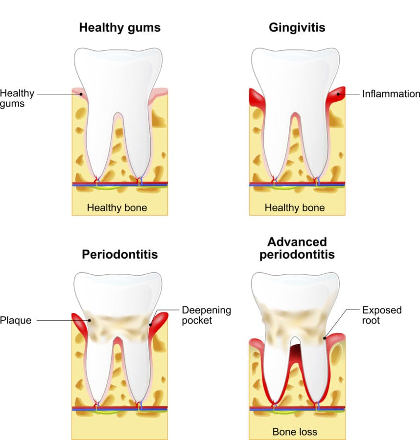 Gum Disease