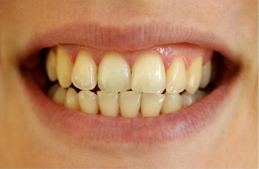 Teeth whitening Phoenix, AZ Teeth whitening Phoenix, AZ