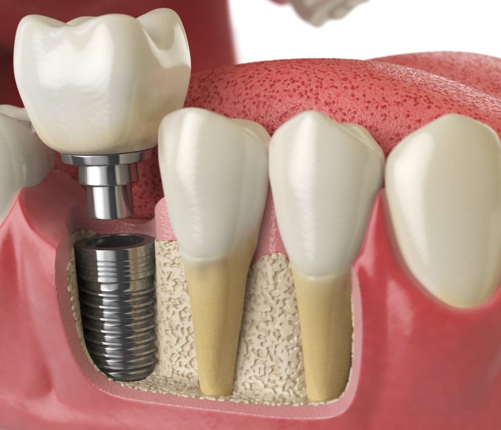 diagram of implants going in jaw