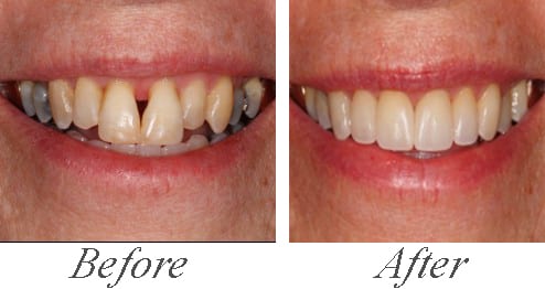 Invisalgin with Veneers Before and After Photo