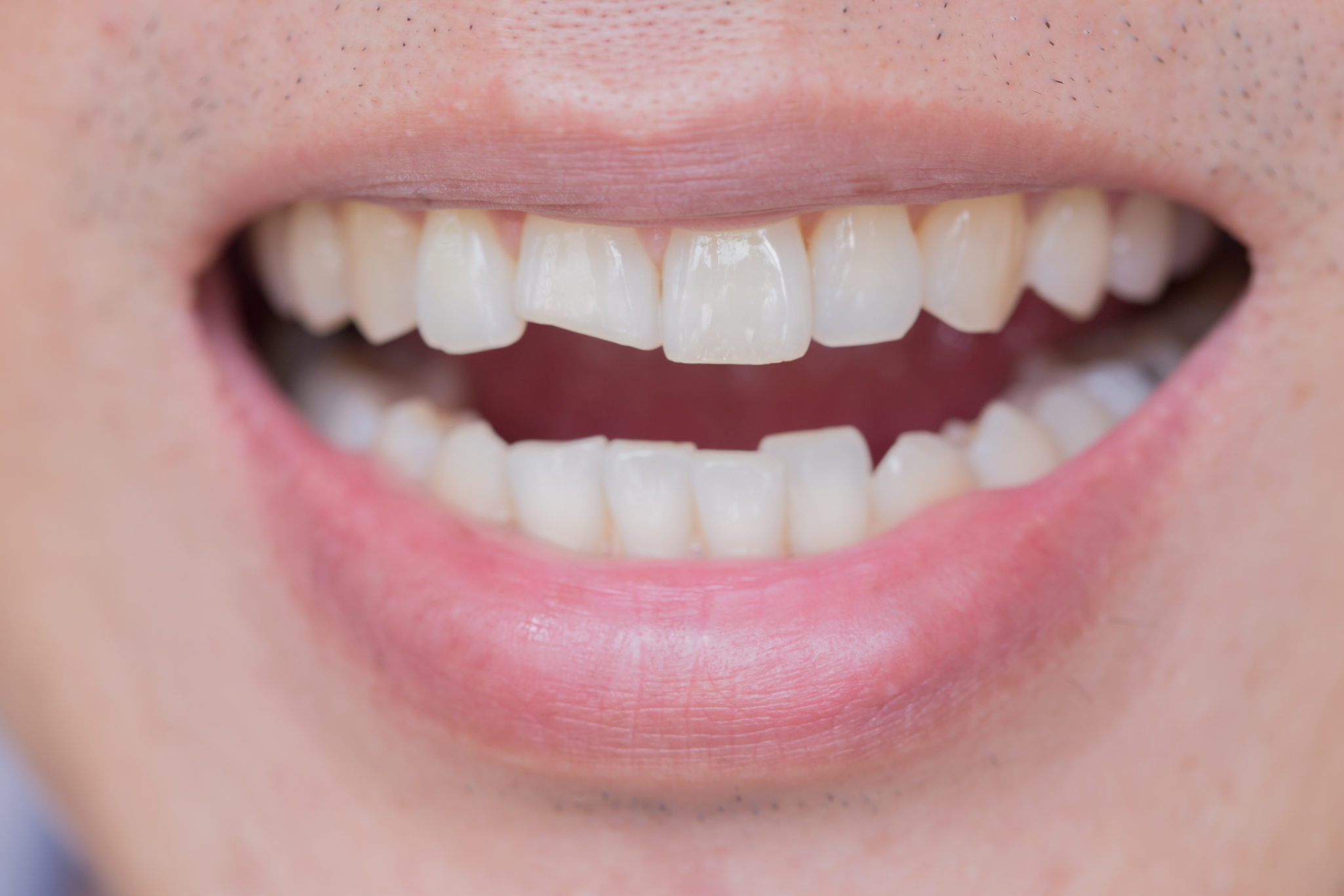 A young man with a chipped front tooth, candidate for dental bonding and cosmetic dentistry