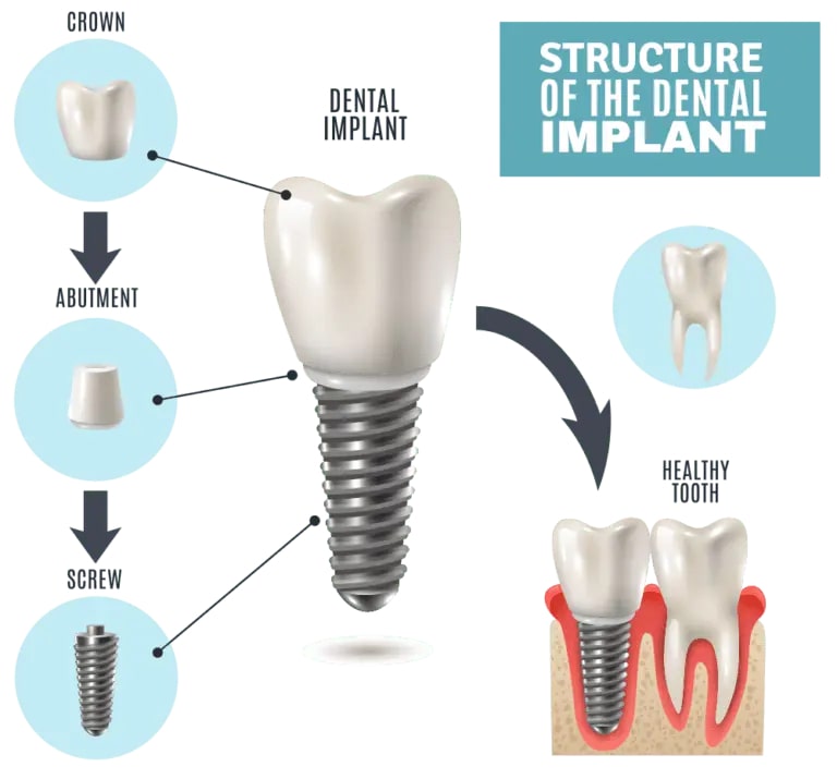 diagram of dental implant and jaw