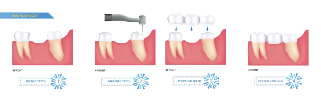 medical diagram of dental bridges