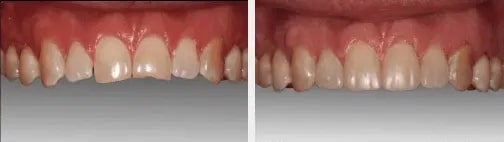 before and after dental bonding treatment in phoenix, arizona