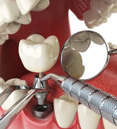 dental implants specialist phoenix AZ