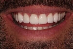 Whitening and Veneers