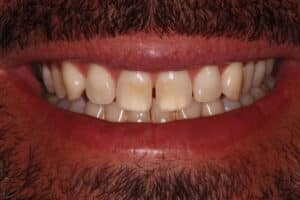 Whitening and Veneers