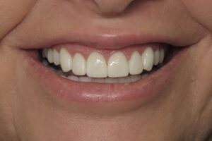Veneers