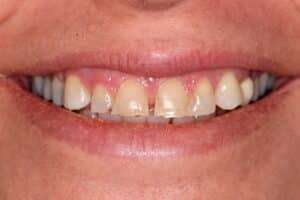 Veneers