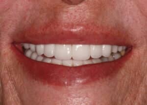 Veneers