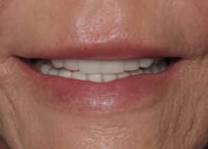 Veneers