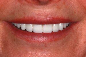 Veneers