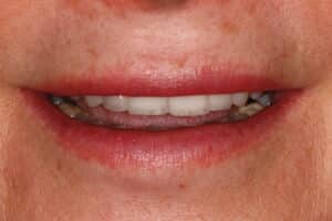 Veneers
