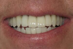 Kor Teeth Whitening and Veneers