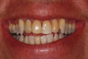 Kor Teeth Whitening and Veneers