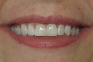 Kor Teeth Whitening and Composite Bonding