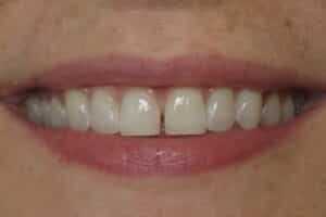 Kor Teeth Whitening and Composite Bonding