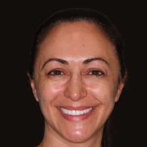 Composite Veneers