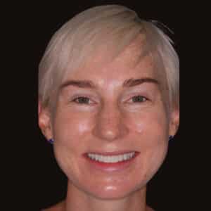 Kor Whitening and Veneers