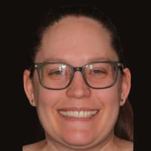 Composite Veneers