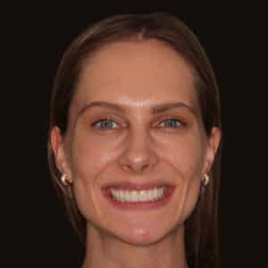 Kor Teeth Whitening and Composite Bonding
