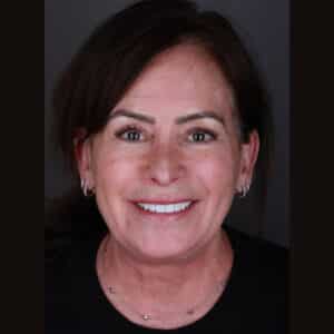 Veneers