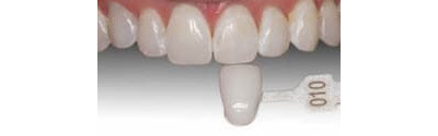 Kor Teeth Whitening Patient 1