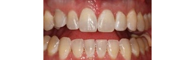Kor Teeth Whitening Patient 1