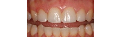 Orthodontics And Crown Patient 1