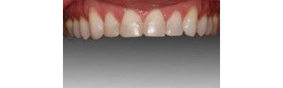Orthodontics And Crown Patient 2