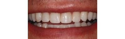 Orthodontics And Crown Patient 2