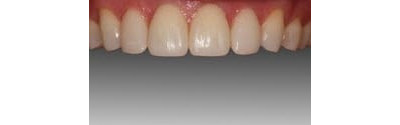 Orthodontics And Crown Patient 3