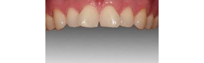 Orthodontics And Crown Patient 3