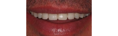 Orthodontics And Crown Patient 3