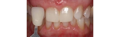 Kor Teeth Whitening Patient 2