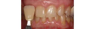 Kor Teeth Whitening Patient 2