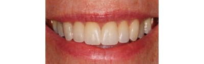 Invisalign and Veneers Patient 1