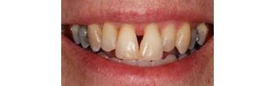 Invisalign and Veneers Patient 1